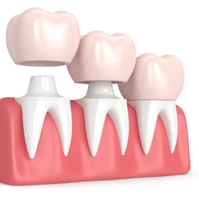 dental-crown (1)