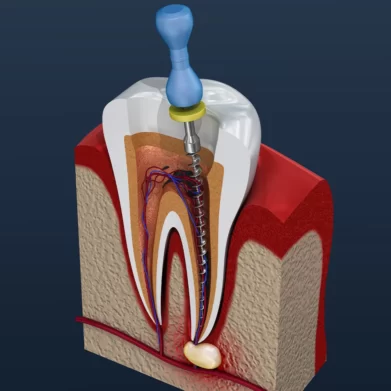 root-canal-treatment